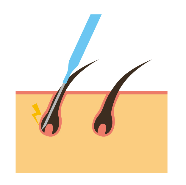 ニードル/針/脱毛のイラスト