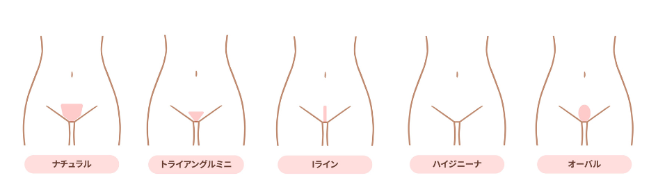 人気のVIOデザイン5タイプ・イラスト